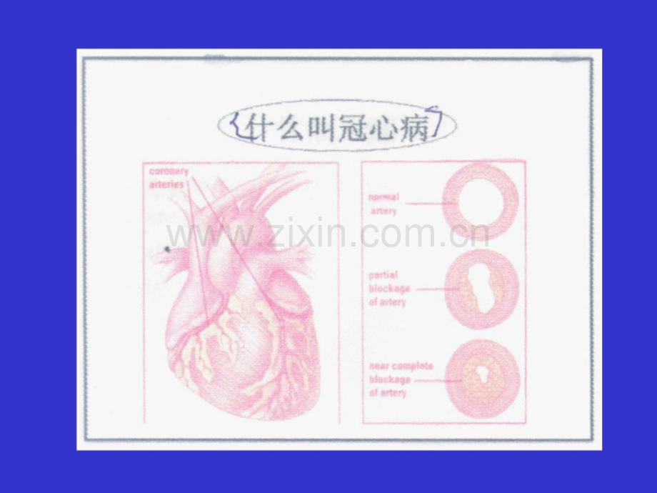 冠芥蒂防备治疗康复.ppt_第2页