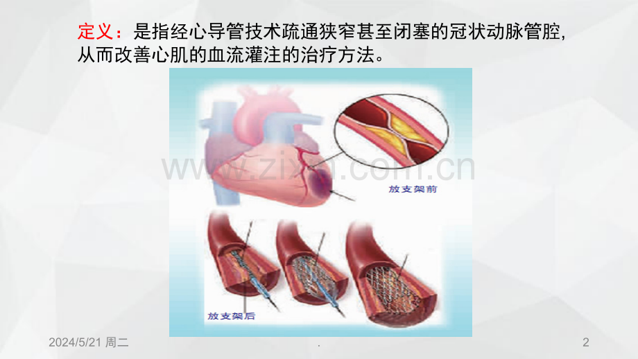 经皮冠状动脉介入治疗.ppt_第2页