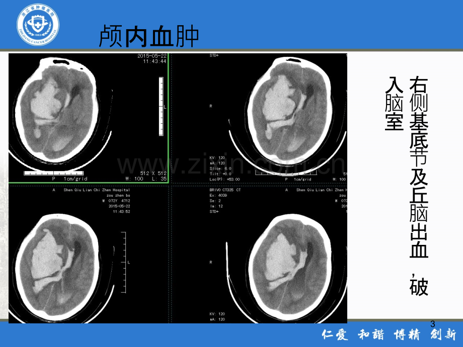 危急值---CT-.ppt_第3页