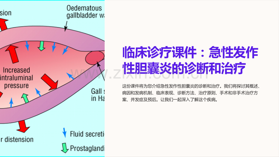 《临床诊疗课件：急性发作性胆囊炎的诊断和治疗》.ppt_第1页