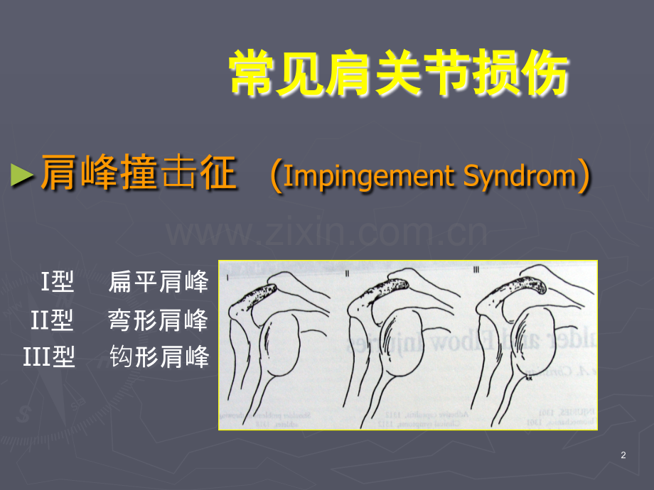 肩关节镜手术期护理要点.ppt_第2页