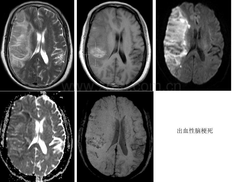 中枢题目常见病、多发病.ppt_第2页