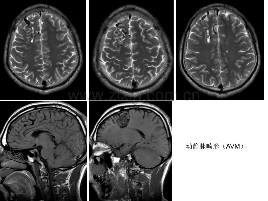 中枢题目常见病、多发病.ppt_第3页