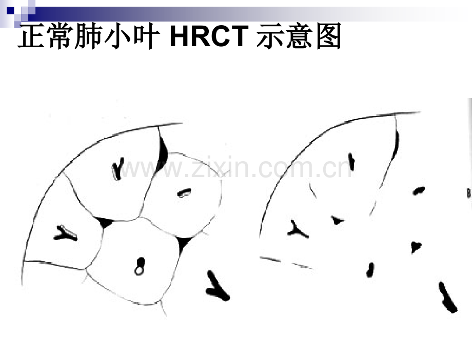 肺部间质病的基本病变影像.ppt_第3页