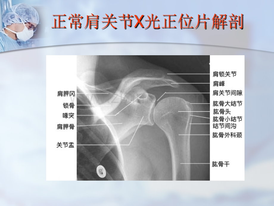 肱骨近端骨折讲稿.ppt_第3页