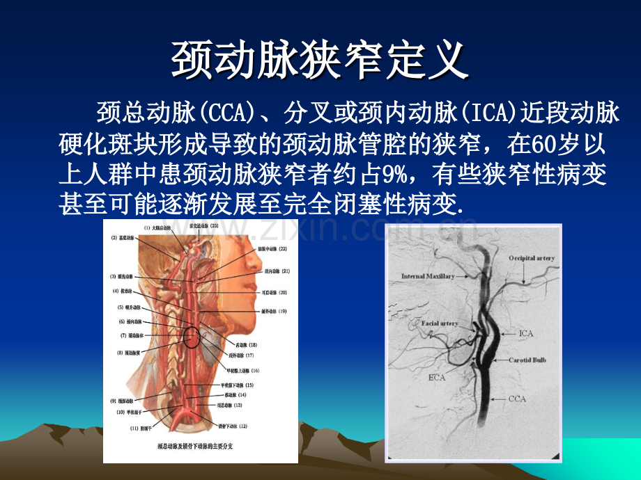 颈动脉狭窄支架介入治疗.ppt_第2页