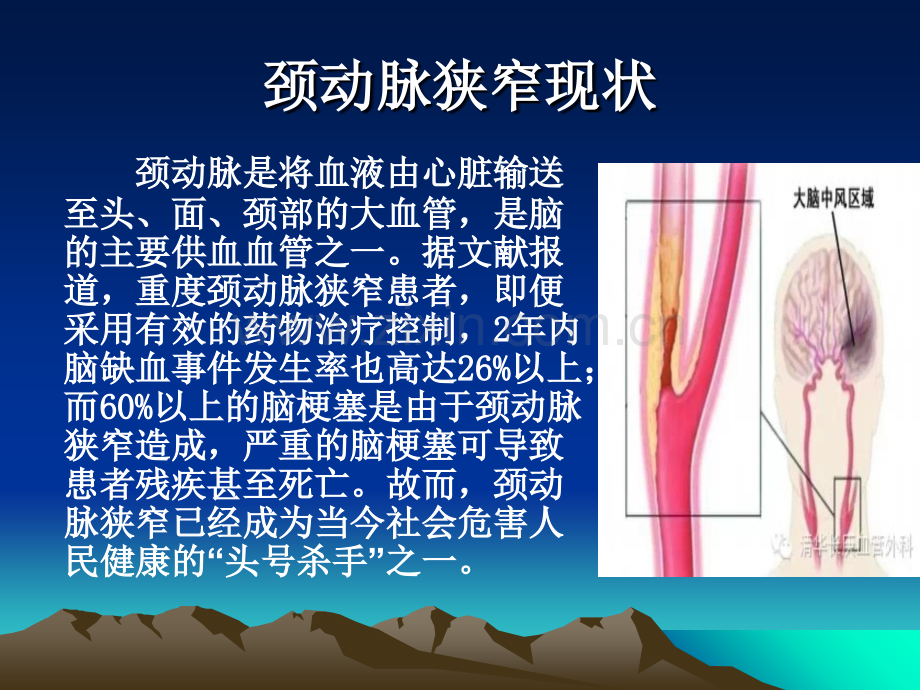 颈动脉狭窄支架介入治疗.ppt_第3页