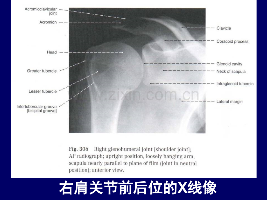 上肢的断层解剖-人体断层解剖学--19.ppt_第3页