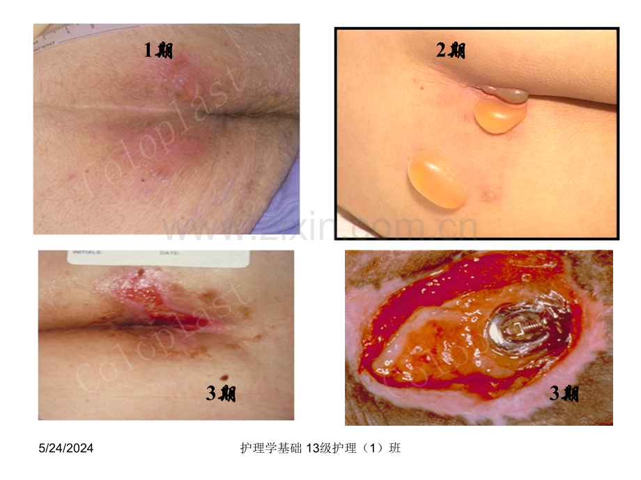 压疮预防及护理--1-PPT课件.ppt_第3页