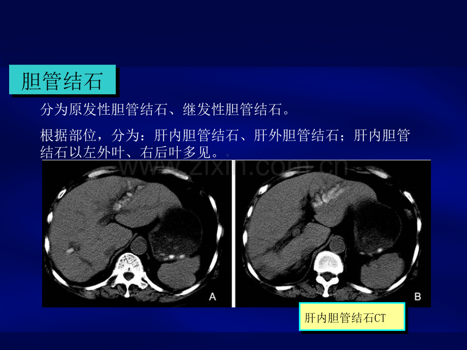 肝胆管结石诊断和治疗PPT课件.ppt_第2页