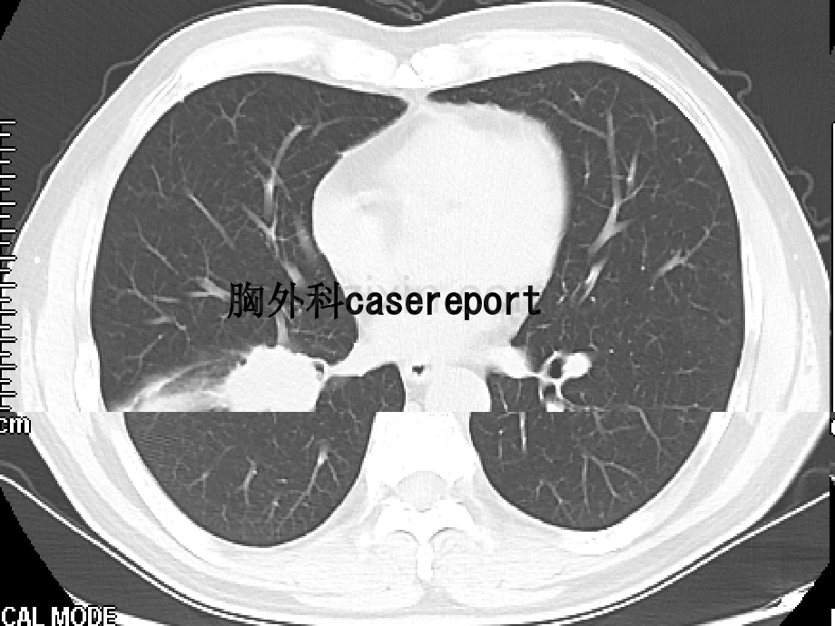 胸外科casereport.ppt_第1页