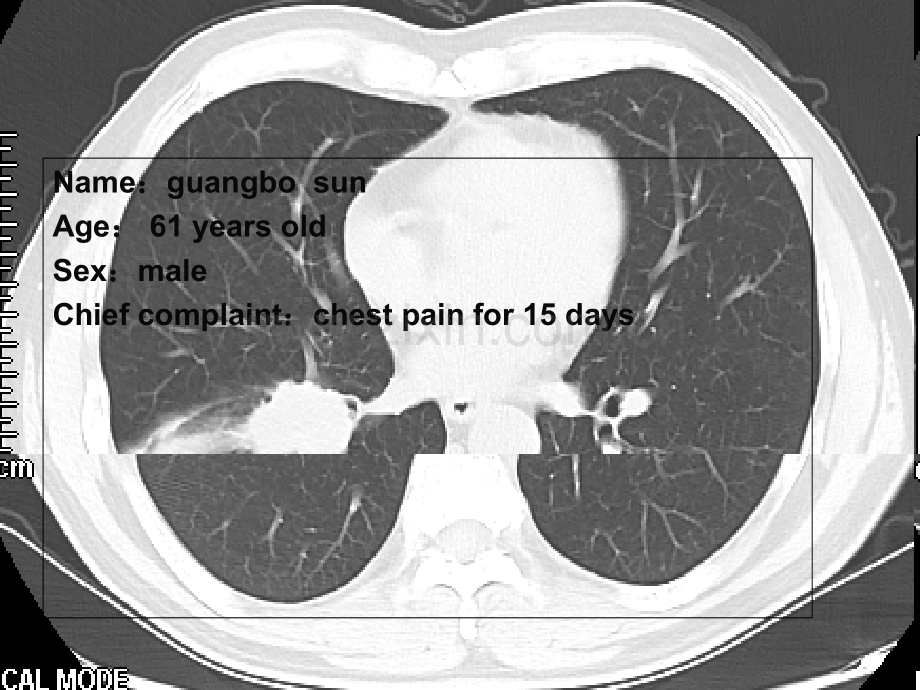 胸外科casereport.ppt_第2页