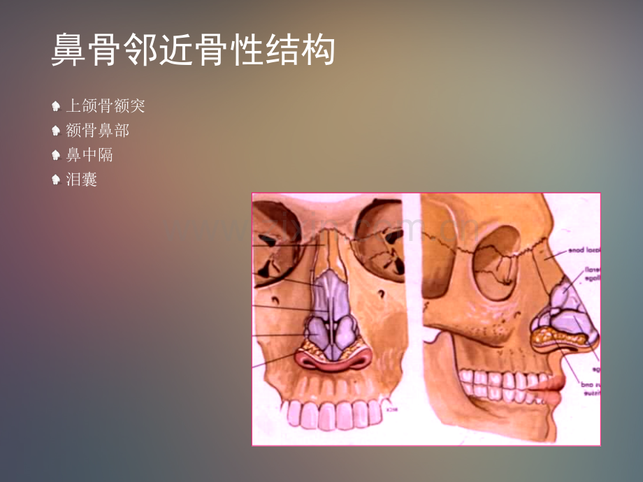 鼻骨骨折影像学诊断与鉴别.ppt_第3页