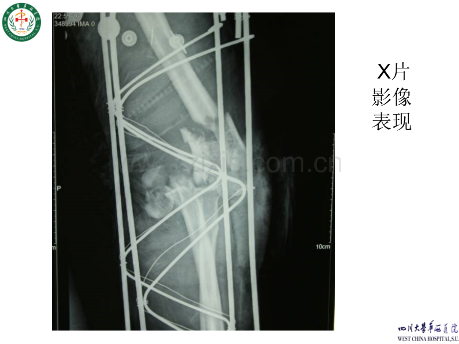 肱骨远端复杂骨折案例.ppt_第3页