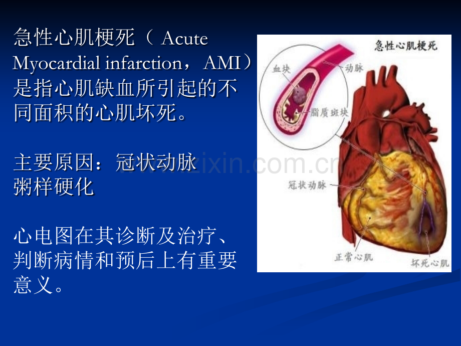 试讲心肌梗死.ppt_第2页