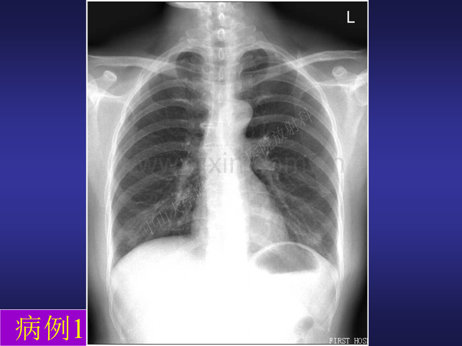 呼吸系统X线解剖、正常表现、基本病征PPT课件.ppt_第2页