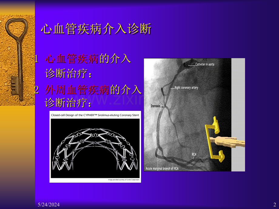 心血管疾病介入诊断治疗护理-课件PPT课件.ppt_第2页