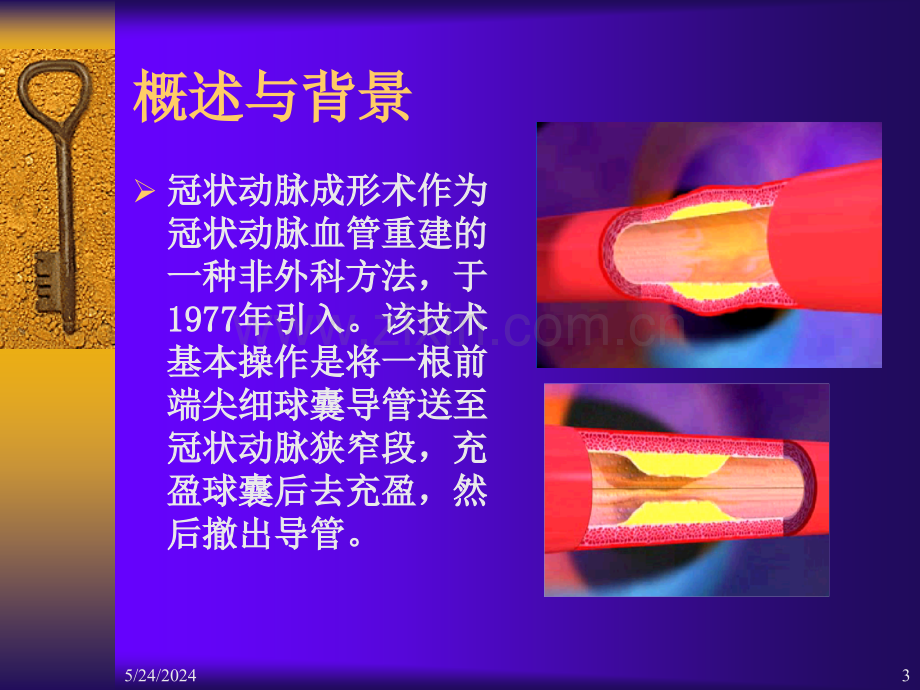 心血管疾病介入诊断治疗护理-课件PPT课件.ppt_第3页