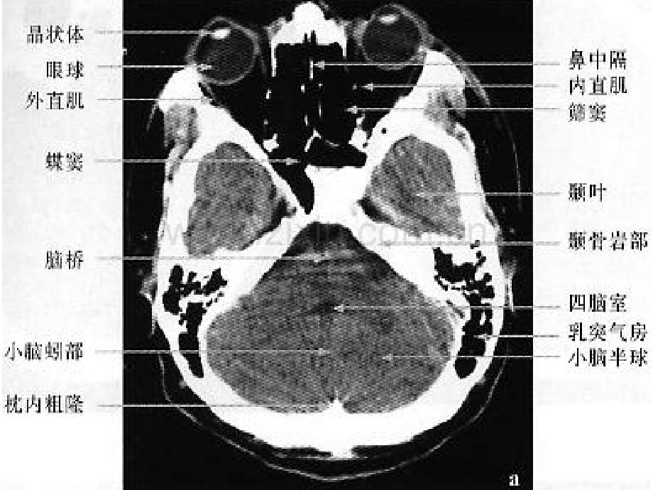 正常头颅ct与mri图解.pptx_第3页