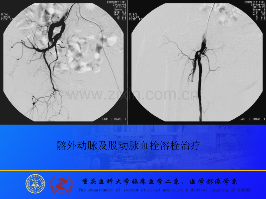 化疗药物灌注治疗PPT课件.ppt_第3页