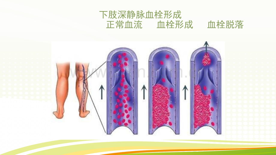 深静脉血栓病人的护理.pptx_第3页