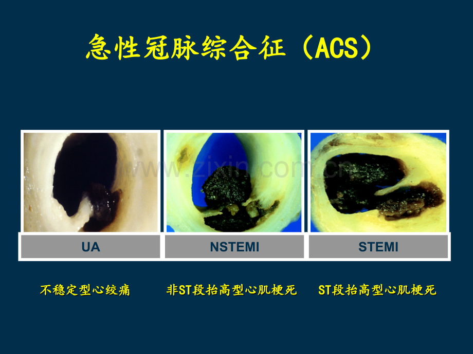 急性st段抬高心肌梗死指南解读.ppt_第2页