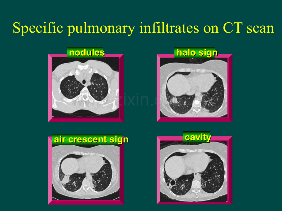 肺隐球菌感染的影像学改变.pptx_第3页