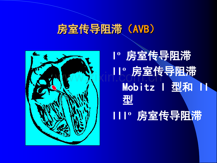 心律失常心脏传导阻滞.ppt_第2页