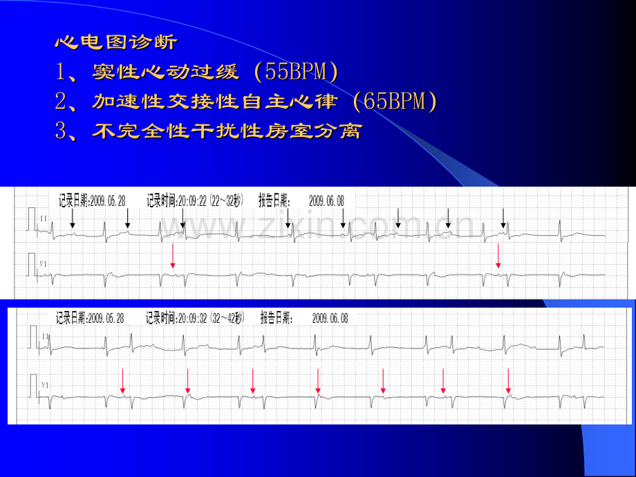 心律失常心内科.ppt_第3页