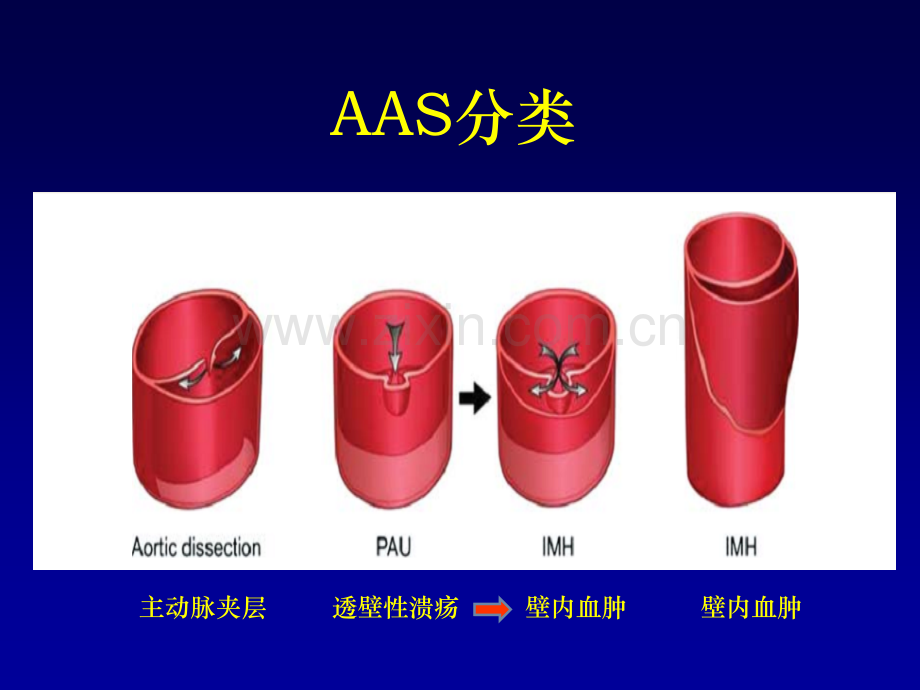 急性主动脉综合征处理过程中应注意的几个问题.ppt_第3页