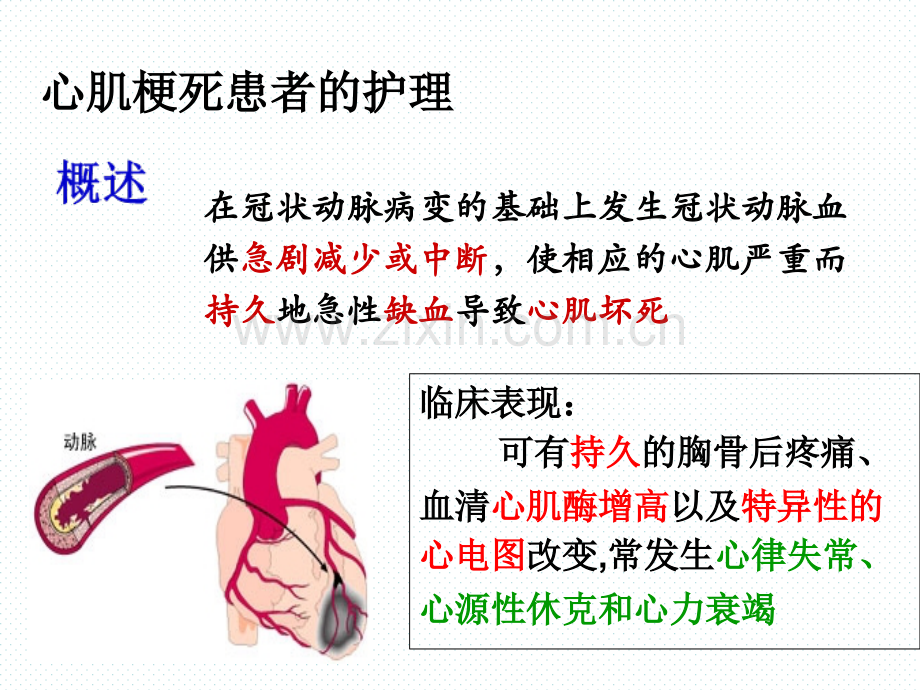 心梗治疗与护理的业务学习.ppt_第2页