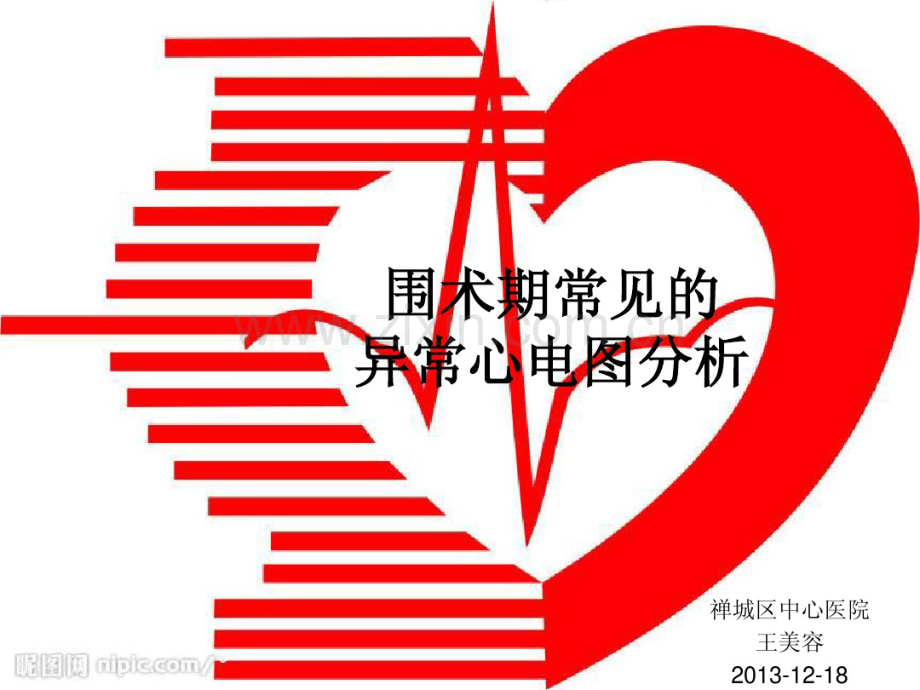 围术期常见的异常心电图分析.pdf_第1页