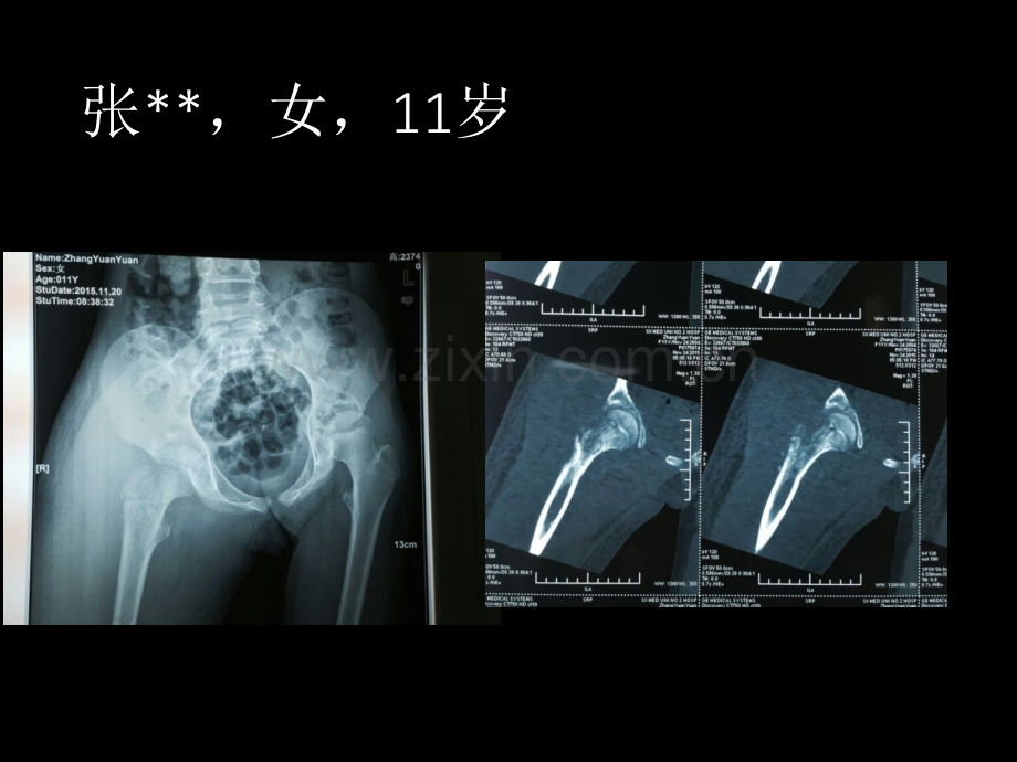 外科PPT课件骨与关节的化脓性感染(ppt文档).ppt_第3页