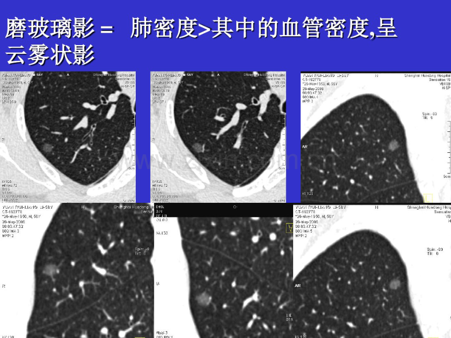 弥漫及单发肺磨玻璃病变的CT诊断-(2).pdf_第2页