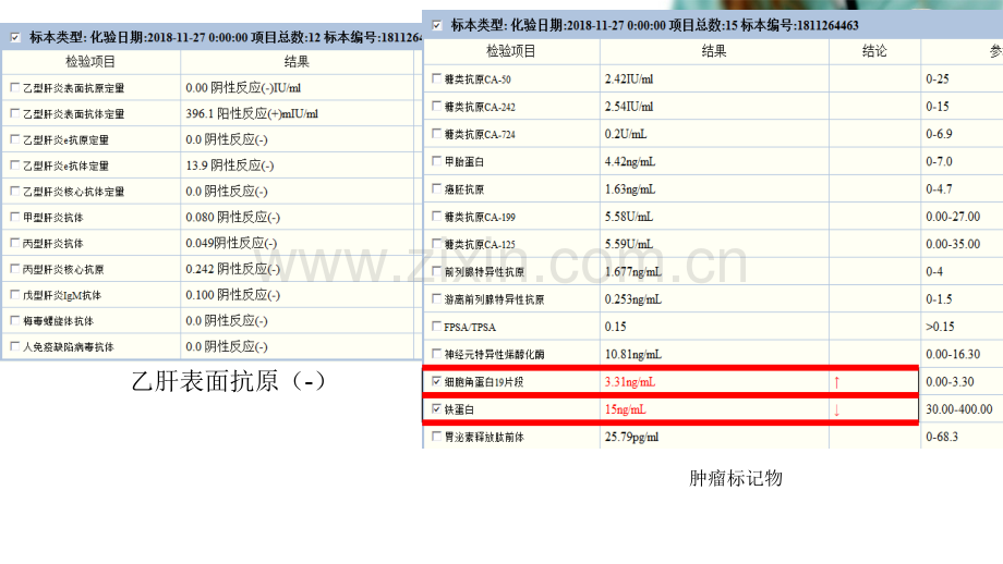 肝脏上皮样血管内皮瘤影像学表现.ppt_第3页