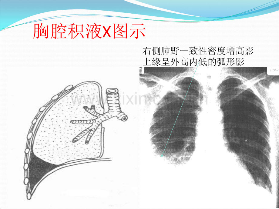 胸穿、腹穿(ppt文档).ppt_第3页