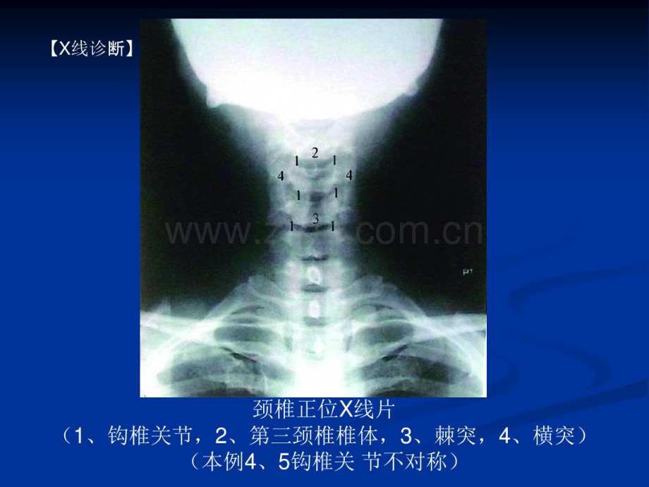 脊柱的影像学诊断.pdf_第2页