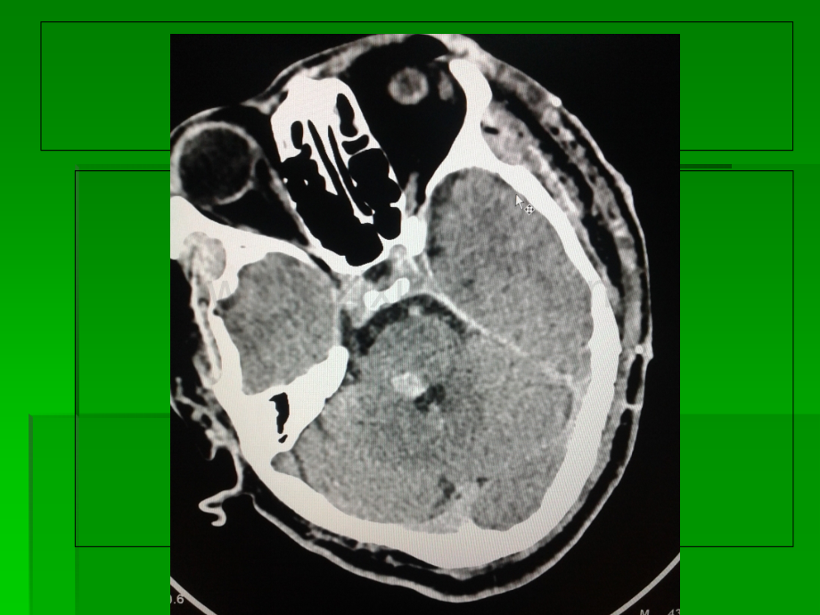 脑干海绵状血管瘤MRI.ppt_第3页