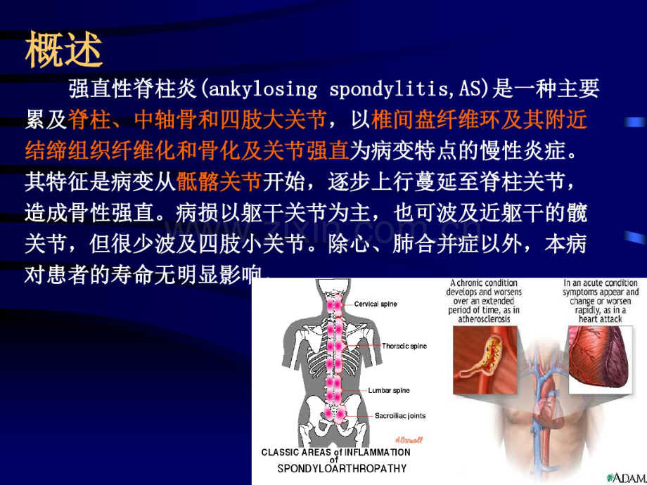 强直性脊柱炎-(2).pdf_第2页