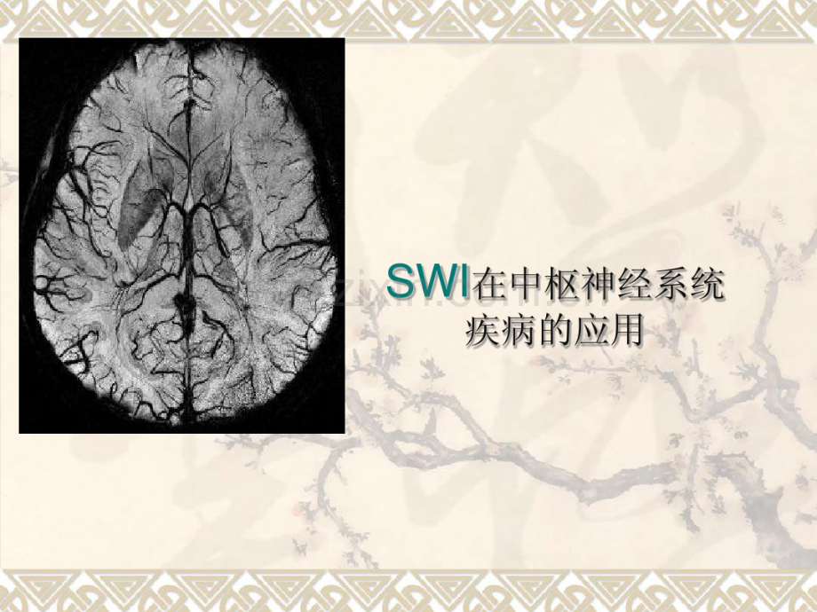 SWI在中枢神经系统应用.pdf_第1页