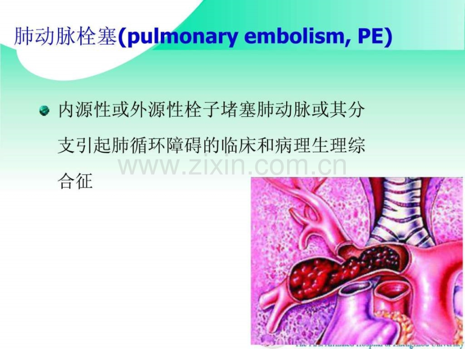 肺栓塞的CTA表现.ppt.ppt_第2页