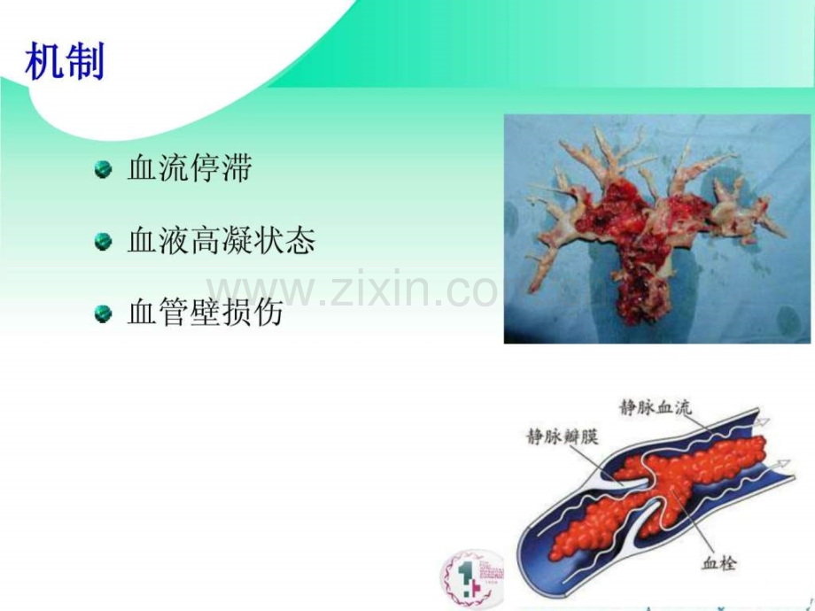 肺栓塞的CTA表现.ppt.ppt_第3页