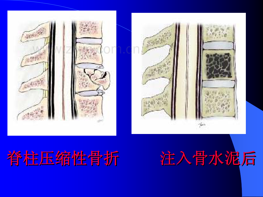 椎体成型术.pdf_第3页