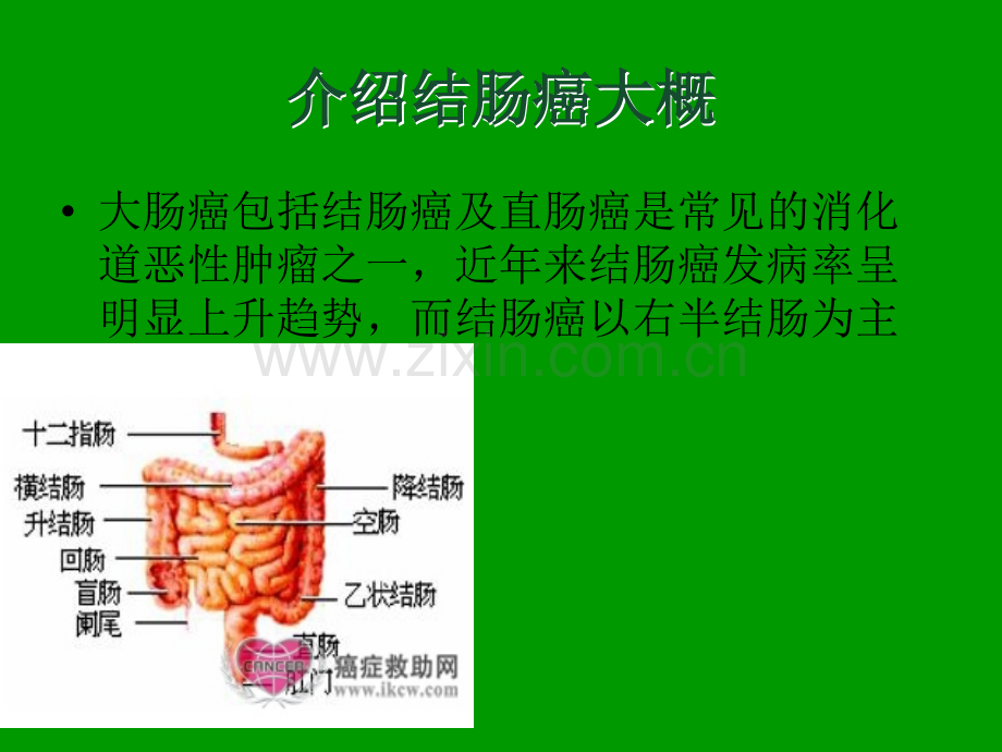 2014结肠癌教学查房.ppt_第2页