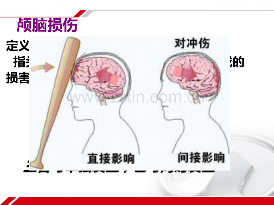 颅脑损伤病人的护理【可编辑的PPT文档】.ppt_第2页