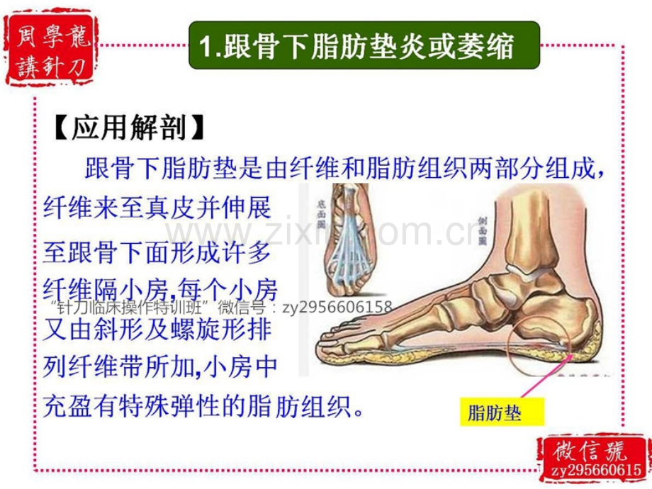 讲针刀—跟痛症的分型与针刀治疗.ppt_第3页