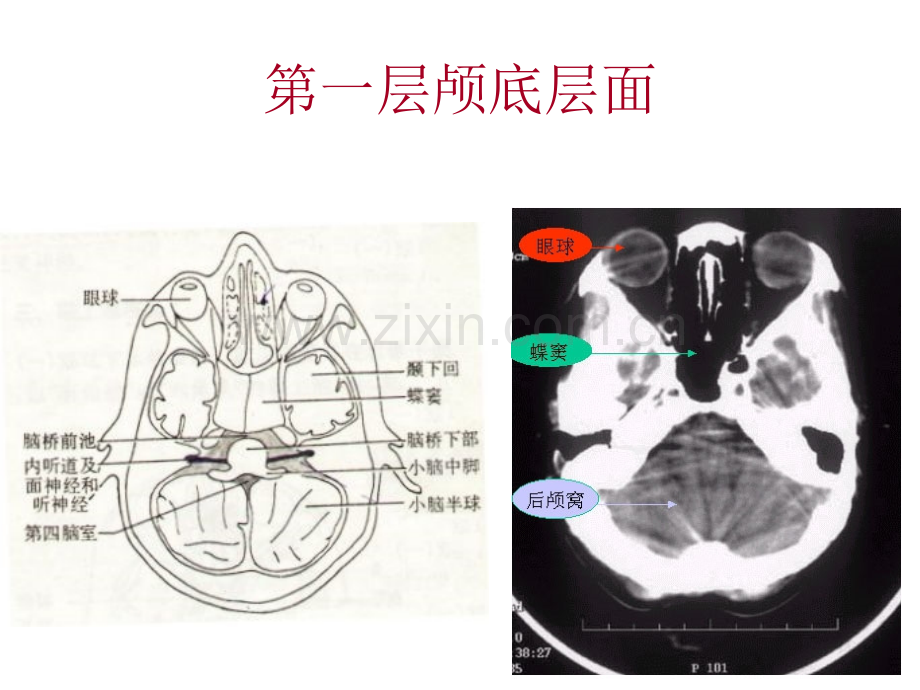 颅脑基本病变的CT诊断.ppt_第1页