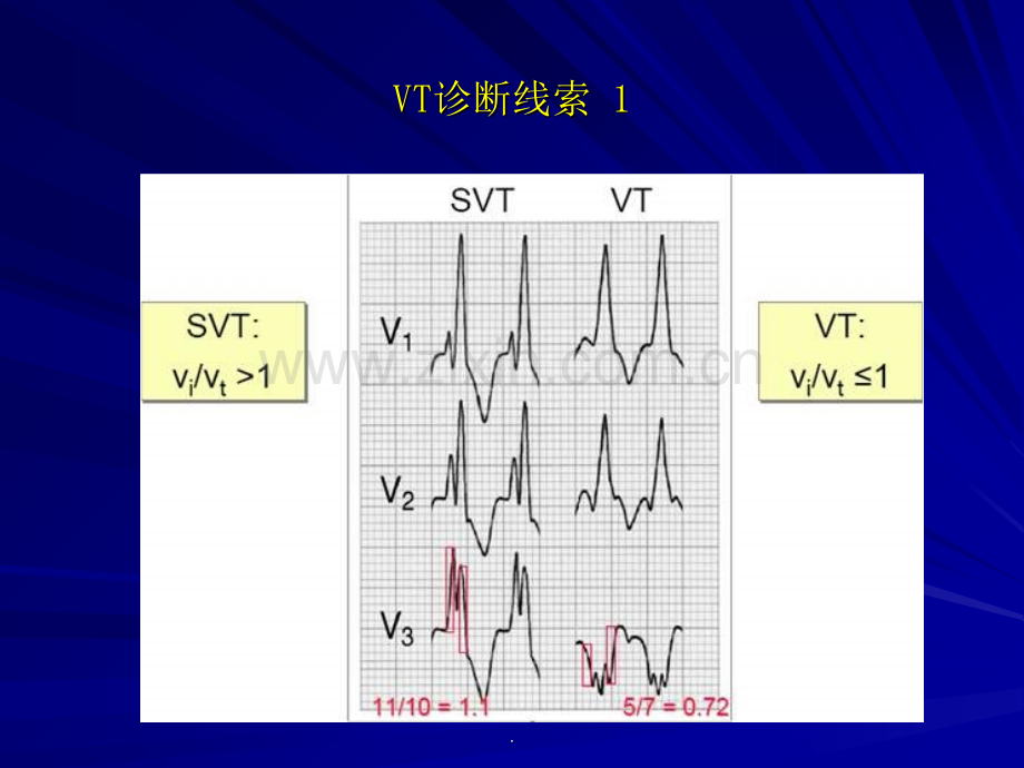 室性心律失常.ppt_第3页