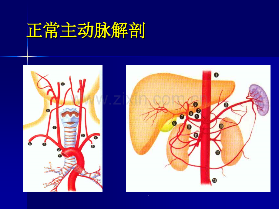 主动脉夹层及腹主动脉瘤CTA影像.ppt_第3页