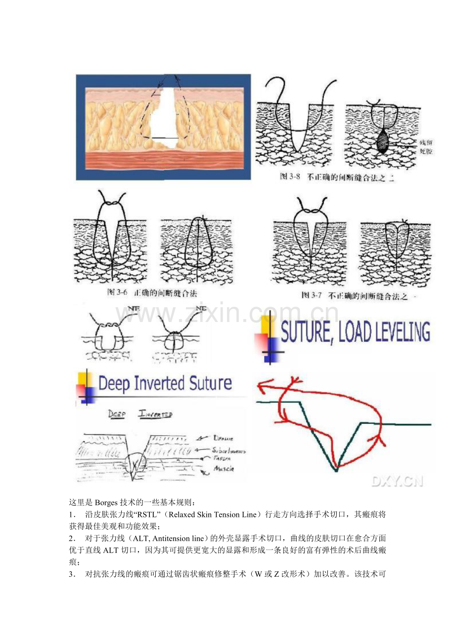 米拉德缝合技巧要点.doc_第2页